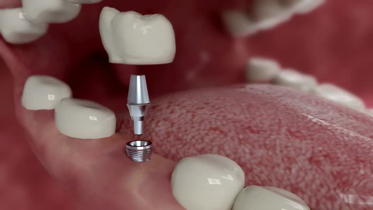 Premium Dental Implants Fort Worth Residents Can Trust